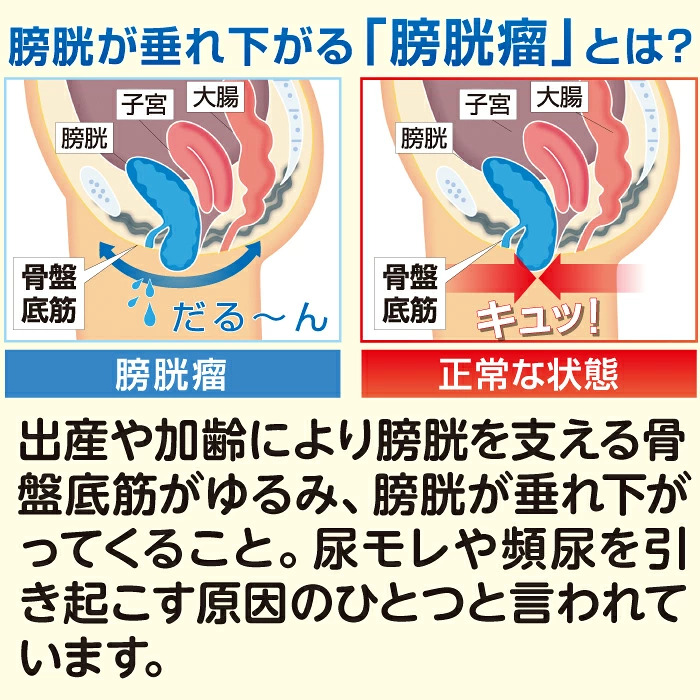 日本製 骨盤底筋ベルト モレナレディ 2枚組 膀胱瘤 尿漏れ